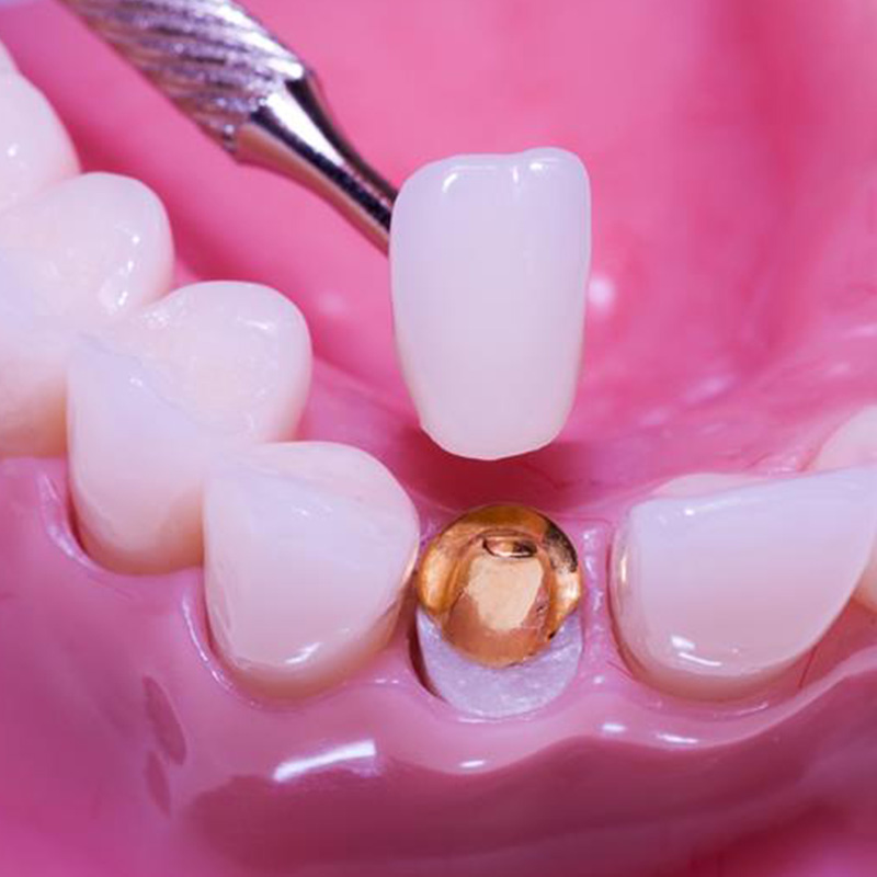 Porcelain Crowns