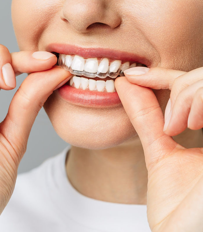Patient wearing Invisalign clear liners